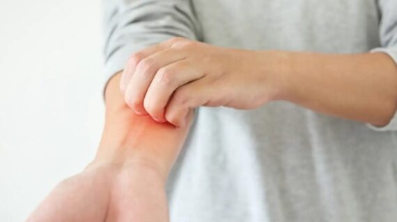 Apa Itu Dermatitis Atopik (Eksim)?